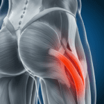 cuerpo anatomico lesion en isquitibial, muslo